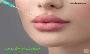 تصویر ژل لب روسی طبیعی